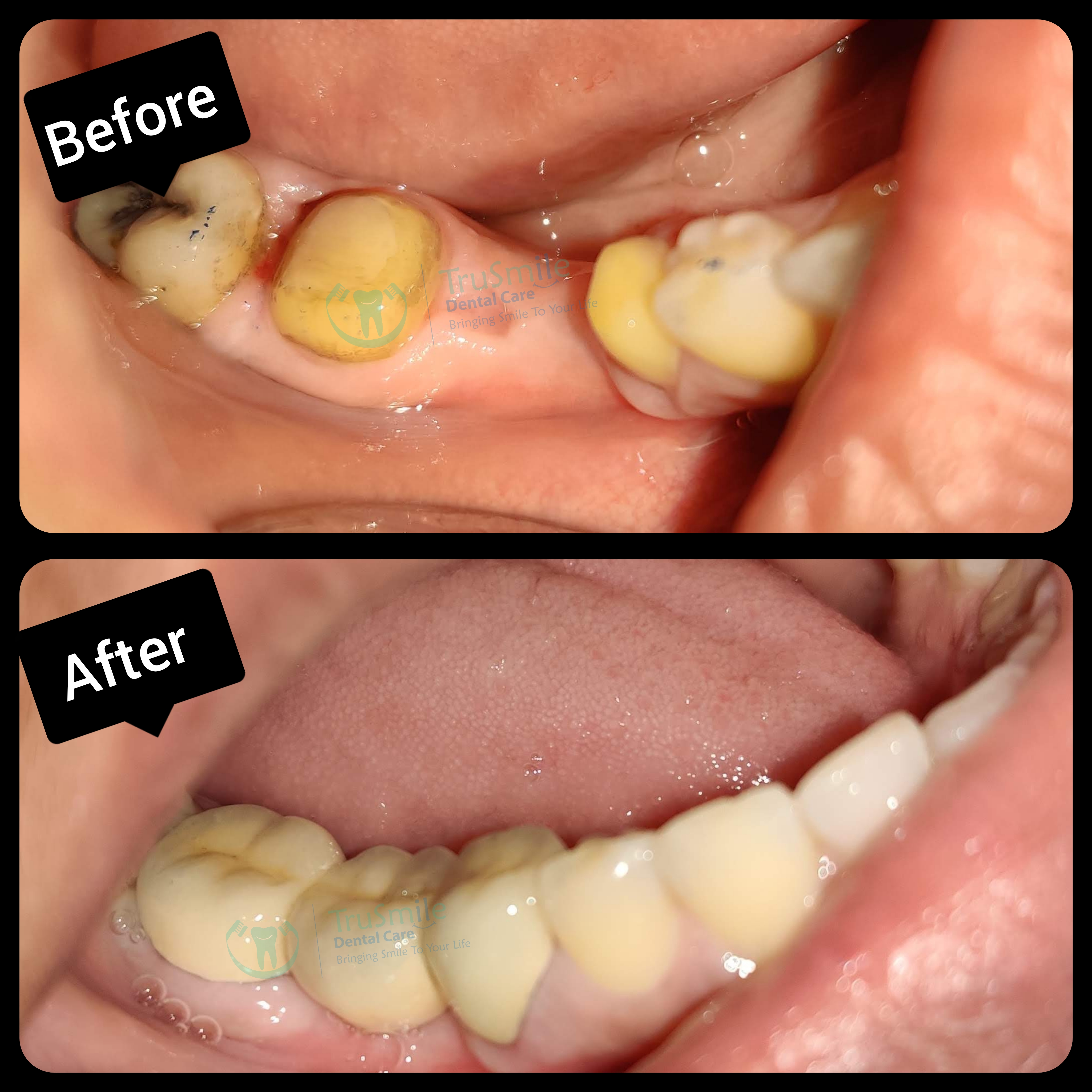 Zirconia 1